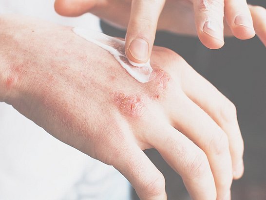 Behandlung juckender, trockener Hände mit Salbe bei Neurodermitis und atopischer Dermatitis